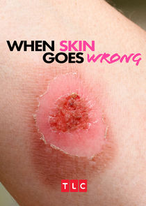 When Skin Goes Wrong Ne Zaman?'